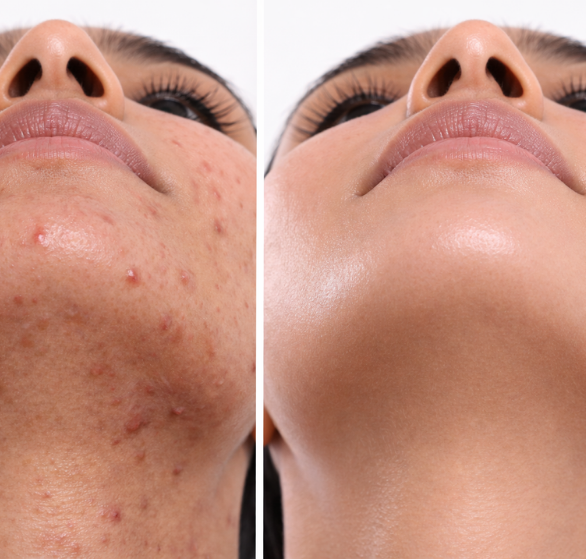 hydrafacial basic